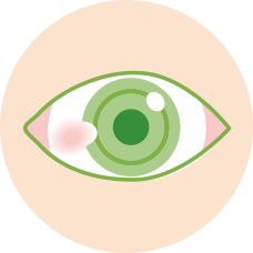 結膜（目の炎症）が角膜に侵入している状態のイラスト