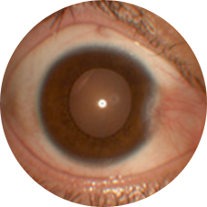 角膜に結膜が侵入してきている状態の実際の写真