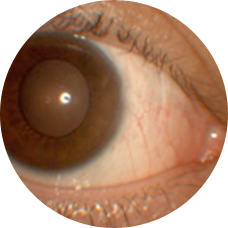 結膜有茎弁移植術後の目の状態の写真
