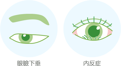 眼瞼下垂と内反症のイメージイラスト